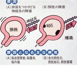 切迫性尿失禁2