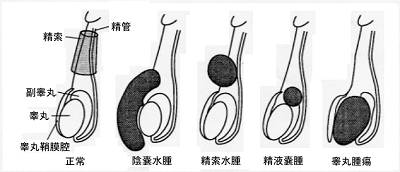 精液瘤 精液嚢腫 Spermatocele