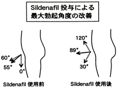 Sildennafil投与による最大勃起角度の改善