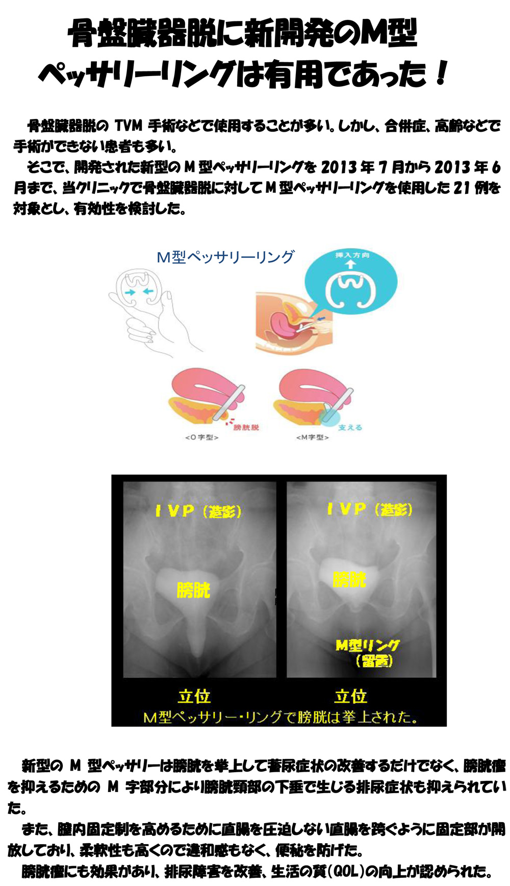 骨盤臓器脱に新開発のm型ペッサリーリングは有用であった